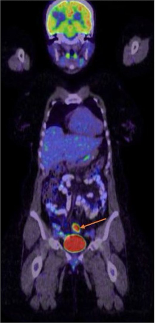 Whole body PET CT scan showing sigmoid colonic tumor with intense metabolic activity. No detectable locoregional lymph nodal or distant metastasis.