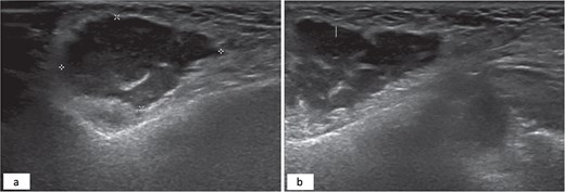 Hypoechoic subcutaneous lesion with an irregular border measuring 3 × 2 cm with internal echoes adjacent to the echogenic fat (a). Internal septation of the hypoechoic lesion (b).