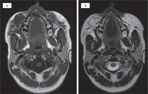 Bilateral injected cosmetic material observed in the subcutaneous tissue of the cheek with the right side showing a subcutaneous hypointense lesion at T1 (a) and a hyperintense lesion at T2 (b) with irregular borders, internal septation, and fat stranding.
