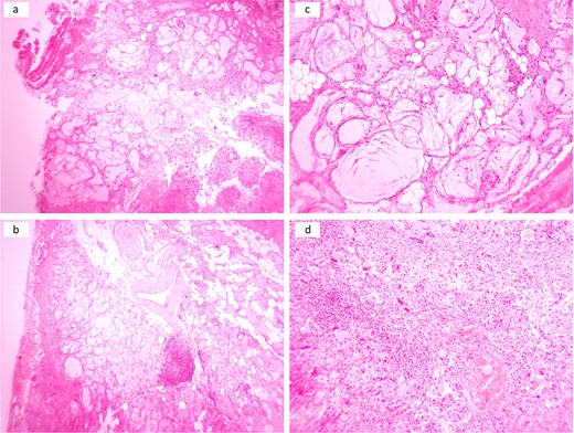 Multiple cystic spaces with amorphous material infiltrating skeletal muscles, adipose tissue, nerves, and large blood vessels with some ruptured spaces leading to exuberant inflammatory reactions (a and b). Cystic spaces with surrounded by palisaded histiocytes and multinucleated giant cells (c). Sheet of histiocytes with scattered multinucleated giant cells and chronic inflammatory cells (d).