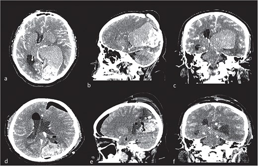 Contrast computed tomography (CT). (a–c) Intraventricular tumor, with a high volume, with the lateral ventricle shape. Different density in the tumor meaning intratumorally hemorrhage. (c–e) Control CT with resection of low-density lesion.