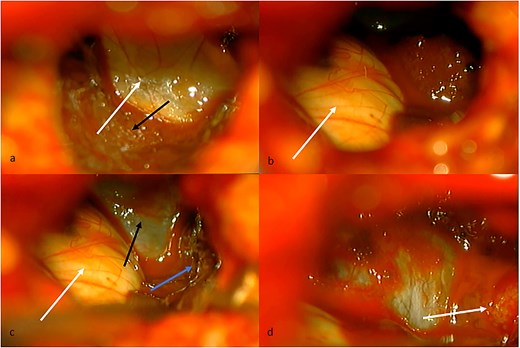 (a) Intraventricular view. White arrow, floor of the left lateral ventricle. Black arrow, tumor tissue covering thalamus. (b) White arrow, thalamus in the anterior, and medial limit of the lateral ventricle. (c) White arrow, thalamus. Black arrow, floor of the lateral ventricle. Blue arrow, tumor tissue covering lateral limit of lateral ventricle. (d) White arrow, choroid fissure with choroid plexus, and choroidal artery.