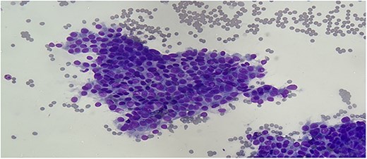 Differentiation quick staining of the thyroid FNA showing cytologic features of classic papillary thyroid carcinoma: oval enlarged nuclei, with nuclear overlapping, intranuclear grooves, and intranuclear cytoplasmic pseudoinclusions (original magnification ×400).