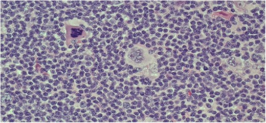 Hematoxylin and eosin staining of the lymph node biopsy showing the presence of large atypical Reed-Sternberg cells (original magnification ×200).