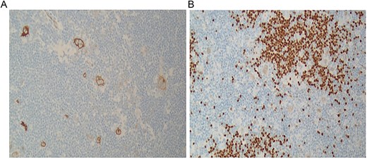 Immunohistochemical staining of the lymph node showing positivity for CD30 (original magnification ×100) (A), and PAX-5 (dim) (original magnification ×400).