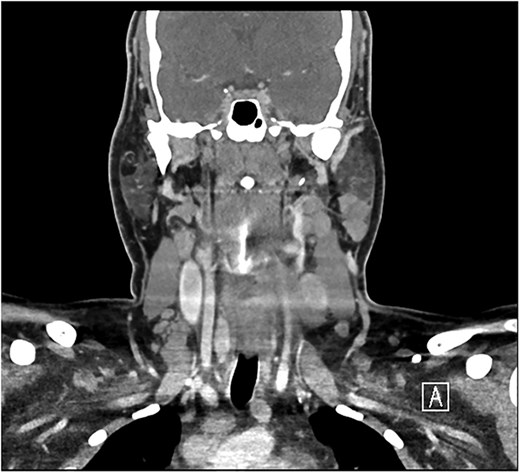 Bilateral enlarged and necrotic left intraparotid, cervical, and supraclavicular lymph nodes.