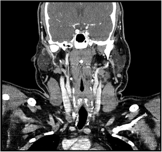 Post-total thyroidectomy and bilateral neck dissection with no signs of recurrence or residual at the thyroid bed. There is a right level IV 11 mm lymph node near the clip of neck dissection.