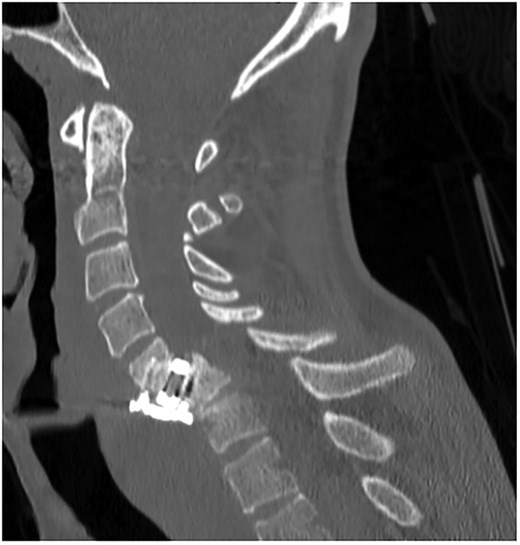 Sagittal CT of initial ACDF at cervical spine C5/C6 level over one year prior to esophageal perforation.