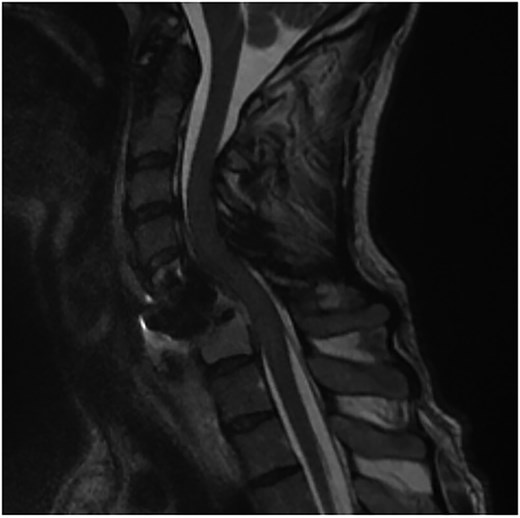 Sagittal T2-weighted MR of prior retropharyngeal abscess that led to revision and posterior plating from C5 to T1.