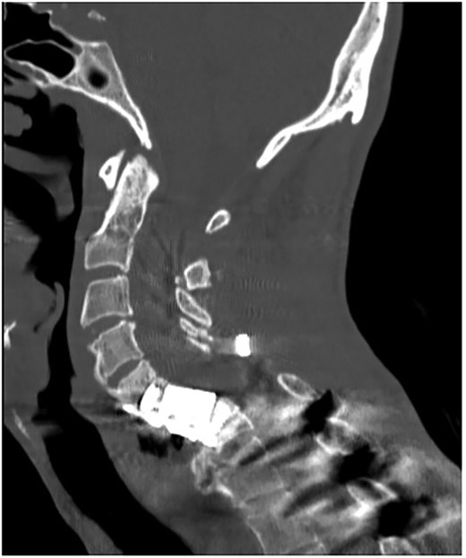 Initial sagittal CT without contrast after patient presented with symptoms of esophageal injury demonstrating increased gas density at the site of C6 corpectomy and post cricoid region.
