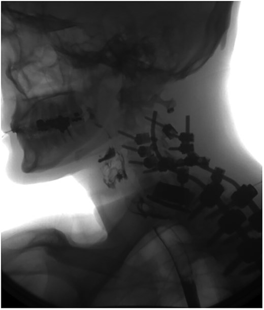 Swallow study demonstrating extraluminal leakage of contrast posteriorly at the C6 level consistent with CT findings.