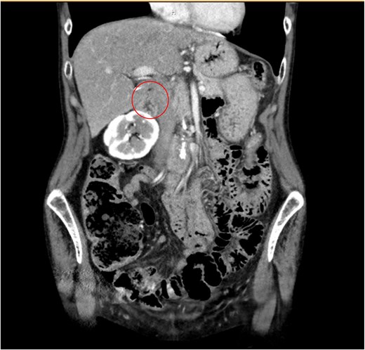 Coronal CT of abdomen and pelvis noting a 1.3 cm right adrenal mass (circle).