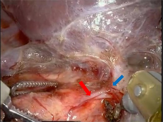 Intraoperative images show the adrenal vein (red arrow) originating from the right hepatic vein (blue arrow).