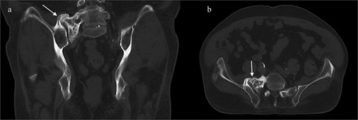 Coronal CT pelvis (left) and axial (right) demonstrated hyperostosis along the right SI joint suggestive of an osteoblastic lesion between the L5 transverse process and sacral ala (arrows).