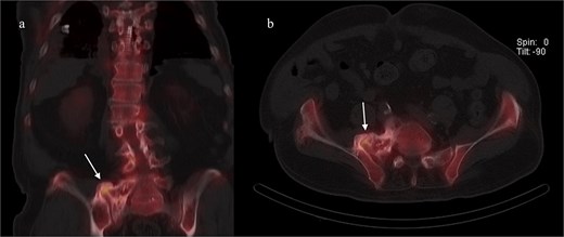 Coronal (left) and axial (right) views of pelvic CT-SPECT highlighted increased uptake along the right SI joint, suggestive of inflammation (arrows).