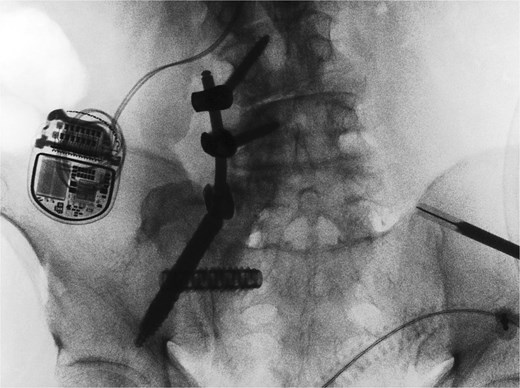 Intraoperative O-arm spin confirmed placement of the right L4 and L5 pedicle screws, as well as the right iliac screw and right sacroiliac implant. The left-sided navigation clamp can be visualized. The patient’s spinal cord stimulator (seen in the figure) was carefully avoided. One can also see the pronounced osseous abnormality along the right lower spine, extending to the sacrum and medial ilium.