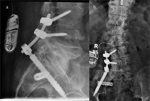 Postoperative lateral (left) and AP (right) re-demonstrated good placement of the hardware.