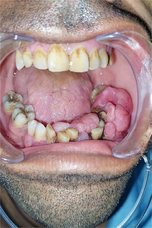 Pre-operative image showing the intraoral appearance of the leiomyosarcoma with gingival hypertrophy.