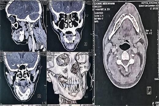 CT scan of the facial mass with axial, coronal, and sagittal slices, as well as 3D reconstructions, showing the tumor and its aggressiveness with cortical lysis at the symphysis.