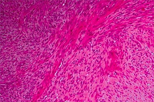 Haematoxylin and eosin stain at ×100 magnification showing a leiomyosarcoma composed of perpendicularly oriented fascicles of spindle-shaped cells.
