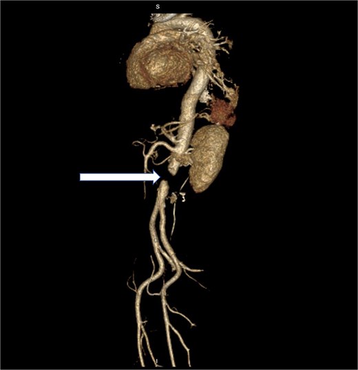 3D reconstructed postoperative CT scan of the abdomen with the arrow showing complete aortic occlusion.