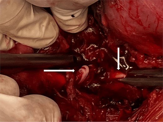 Hemolock clips occluding the aorta.