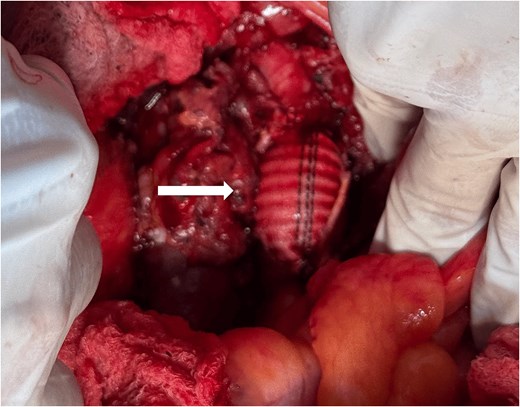 Interposition Dacron graft.
