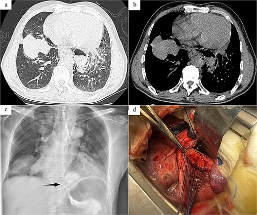 Radiology images and emergency surgery photos of spontaneous esophageal rupture (Case 1). (a and b) Chest and abdomen computed tomography revealed mediastinal emphysema around the lower segment of the esophagus. (c) Esophagus echoendoscopy showed contrast agent leakage into the perihilar region (arrow). (d) Emergency surgery revealed a rupture site located in the lower segment of the esophagus, with a length of about 4.0 cm, and involved interrupted absorbable sutures for full-layer closure of the esophageal perforation.