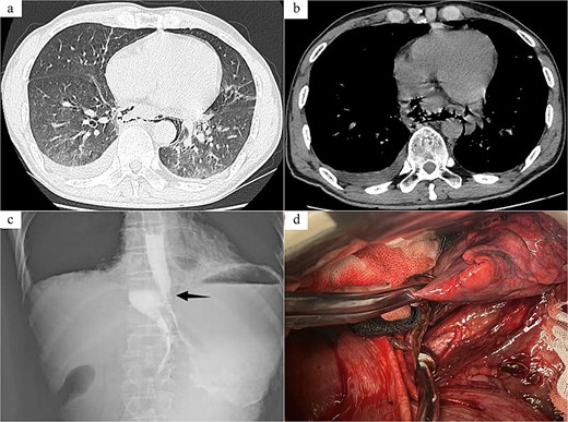 Radiology images and emergency surgery photos of spontaneous esophageal rupture (Case 2). (a and b) Chest and abdomen computed tomography revealed periesophageal air around the lower segment of the esophagus, mediastinal emphysema, multiple air in abdominal cavity, bilateral pleural effusion. (c) Esophagus echoendoscopy showed contrast agent leakage at the distal aboral esophageal segment (black arrow). (d) Emergency surgery revealed a long tear of about 3.0 cm in the posterior wall of the lower esophagus near the cardia.