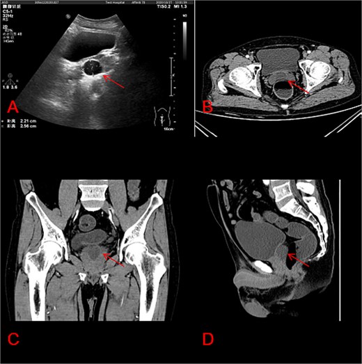 Characteristics of prostate cysts in ultrasound and CT imaging. (A) Prostate cysts in ultrasound; (B) prostate cysts in CT axial section; (C) prostate cysts in CT coronal section; (D) another view of prostate cysts in CT sagittal section.