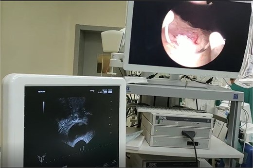 Real-time images are displayed on the cystourethroscope monitor and ultrasound during surgery.