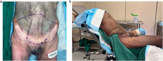 (a) The markings of the three gorges mega-flap are outlined. It incorporates the vascular territories of bilateral deep inferior epigastric artery (DIEA), superficial circumflex iliac artery (SCIA), and superficial external pudendal artery. (b) The specimen was positioned in jackknife to allow for a pinch test that determines the superior limit of the flap.