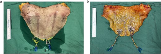 A 17 by 30 cm flap was raised. (a) Size of the skin paddle. (b) The underside of the flap.