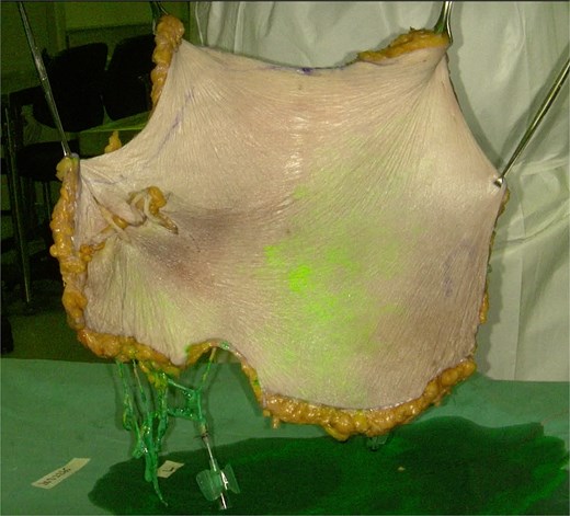 A novel vascular mapping technique is demonstrated using indocyanine green (ICG) angiography. The flap is suspended at its cranial end by tissue-grasping forceps. Both DIEA pedicles were injected in antigravitational manner with 10 ml of ICG solution and flushed with 20 ml of normal saline. Real-time imaging was captured with near-infrared camera.
