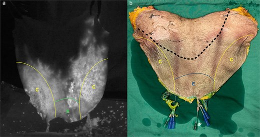 Side-by-side comparison of ICG fluorescent imaging of the flap perfusion against actual territory of the flap. (a) ICG imaging of the flap depicts complete perfusion of bilateral SCIP territory (C) and external pudendal artery territory (E). Fluorescence reached the most cranial aspect of the left DIEP flap territory. (b) Area of the right DIEP flap that was not fully perfused is marked out by dotted black lines.