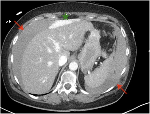 CT of the abdomen. Significant amounts of free fluid in all quadrants (arrows), with fresh blood adjacent to the ventral edge of the left liver lobe (star).