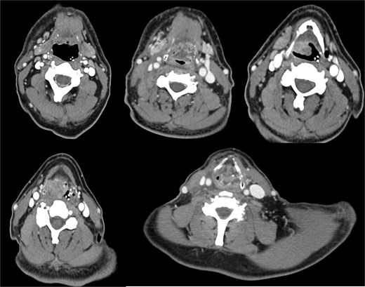 A contrast-enhanced CT scan of the head and neck, in coronal view, revealed a heterogeneous mass in the right supraglottic region, involving the aryepiglottic fold and piriform sinus with full-thickness infiltration. The lesion extended to the paralaryngeal and parapharyngeal spaces, causing obliteration of adipose planes and thyroid cartilage invasion and severe airway reduction.