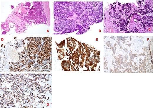 (A–C) Hematoxylin–eosin staining (20×) showing irregular trabeculae and nests of neoplastic cells interspersed with fibrous connective tissue; tumor cells exhibit nuclear pleomorphism, hyperchromasia, a high nuclear-to-cytoplasmic ratio, areas of necrosis and hemorrhage; (D) Ki67 proliferation index; (E) synaptophysin immunostaining (20×); (F) chromogranin a immunostaining (20×); (G) cytokeratin AE1/AE3 (CKAE1/AE3) staining (20×).