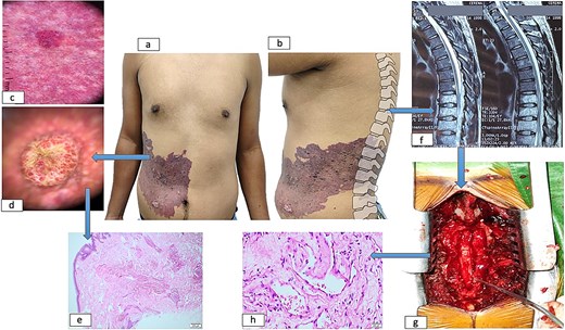 Dermatological and spinal manifestations of cobb syndrome. (a–b) Metamerically distributed cutaneous lesions observed in frontal (a) and sagittal (b) views. (c) Dermoscopic examination reveals a background with linearly distributed vascular structures throughout the lesion, accompanied by lacunae containing scattered dots and globules. (d) Nodular component demonstrates lacunae with central scarring. (e) Histopathological analysis of skin biopsy shows proliferation of capillaries and medium-caliber venous vessels in superficial and mid-dermis. (f) Spinal imaging reveals vertebral and medullary infiltration at thoracic levels. (g) Postoperative spinal column following decompressive laminectomy. (h) Vertebral biopsy confirms vascular infiltration.