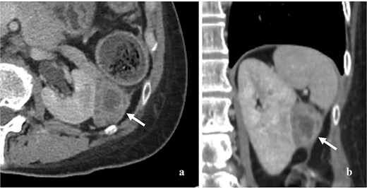 Contrast enhancing CT scan of whole abdomen showed 4.5 × 4 cm heterogeneous and minimal enhancing mass (arrow). (a) Axial section, (b) coronal section.