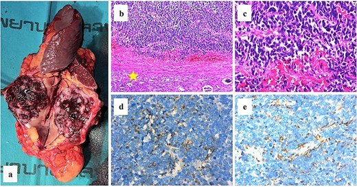 (a) The gross specimen revealed a tan-dark brown rubbery mass measured 5 × 4 cm in size. (b–c) The histological features of hematoxylin and eosin staining were shown and the normal kidney was labeled (star). Immunohistochemical staining results were positive for neuroendocrine markers including chromogranin a (d) and synaptophysin (e).