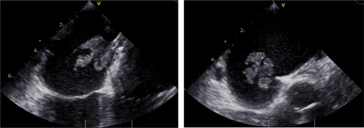 Transesophageal echocardiogram demonstrating mobile vegetation on Gore Cardioform Septal Occluder.