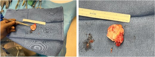 The surgical explanted Gore Cardioform Septal Occluder with surrounding infected atrial septum.