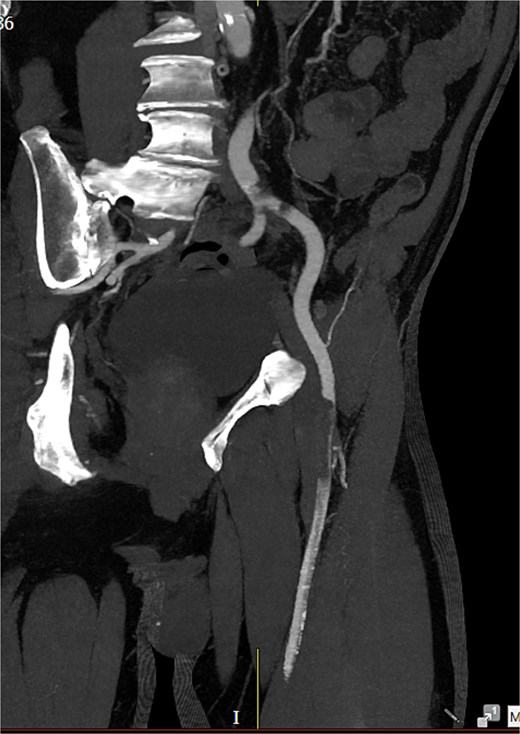 A near-occlusive filling defect at the left common iliac bifurcation. Further embolic material extended into the left common femoral bifurcation, profunda femoris, and superficial femoral artery.
