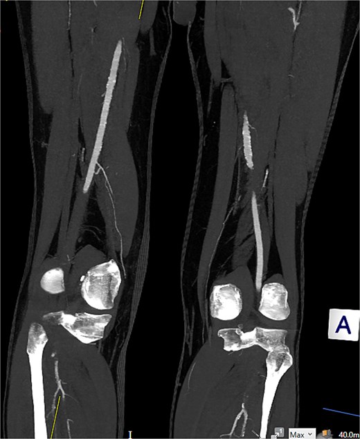 Embolic occlusion of the below-knee popliteal artery extending to the trifurcation, with partial reconstitution of the calf vessels. Emboli are also present in the posterior tibial and peroneal arteries.