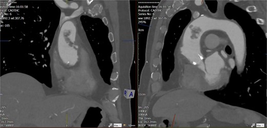 Unstable focal ulceration (1.3 cm) with a 3.5 cm intraluminal filling defect in the ascending aorta. Additional small ulcerations and periaortic soft tissue cuffing are present, along with anterior mediastinal stranding indicative of aortitis.