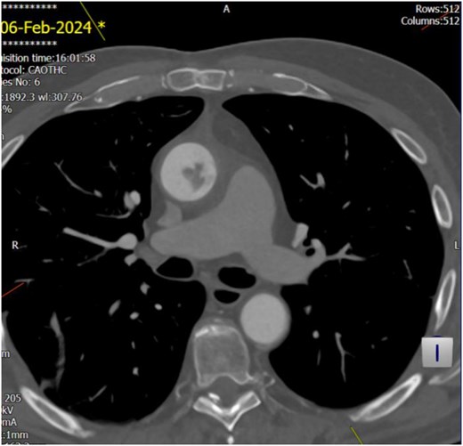 Unstable focal ulceration (1.3 cm) with a 3.5 cm intraluminal filling defect in the ascending aorta. Additional small ulcerations and periaortic soft tissue cuffing are present, along with anterior mediastinal stranding indicative of aortitis.