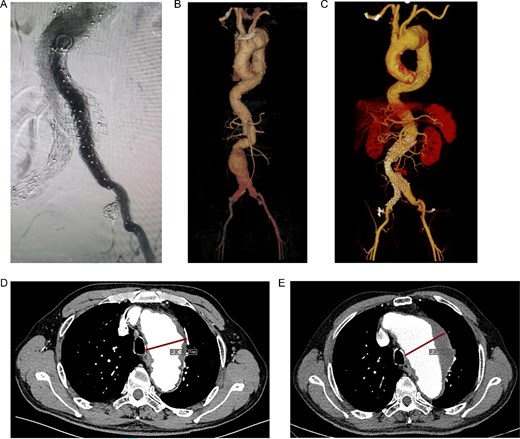 (A) Internal iliac artery embolization and stent graft implantation were performed. (B) Preoperative aortic CTA in 2019. (C) Type Ib endoleak from left iliac artery stent graft. (D) CTA shows the diameter of aortic arch aneurysm was 61.15 mm in July 2019. (E) CTA shows the diameter of aortic arch aneurysm was 72.64 mm in July 2022.