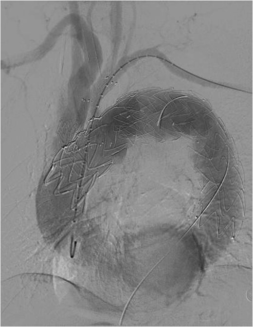 Reconstruction of the three branches of the arch (F/B TEVAR).