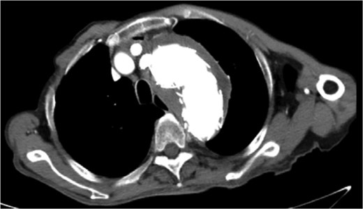 No endoleak was observed upon reexamination in May 2023.